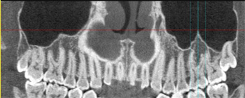 歯列弓に沿った断層像
