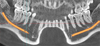 歯列弓に垂直な断層像