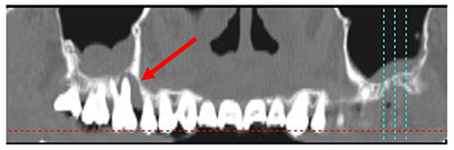 上顎第一大臼歯の近心根が原因