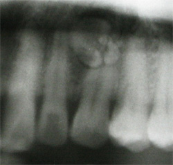 歯牙種