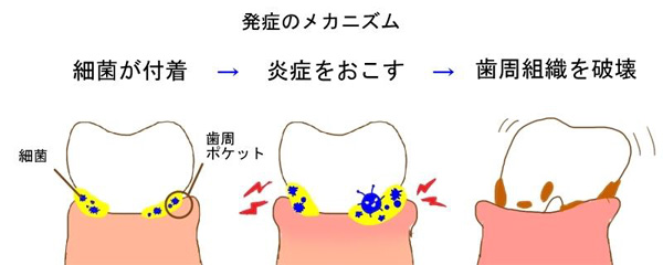 歯周病発症のメカニズム