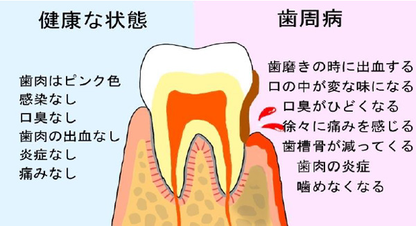 歯肉炎と歯周病の違い