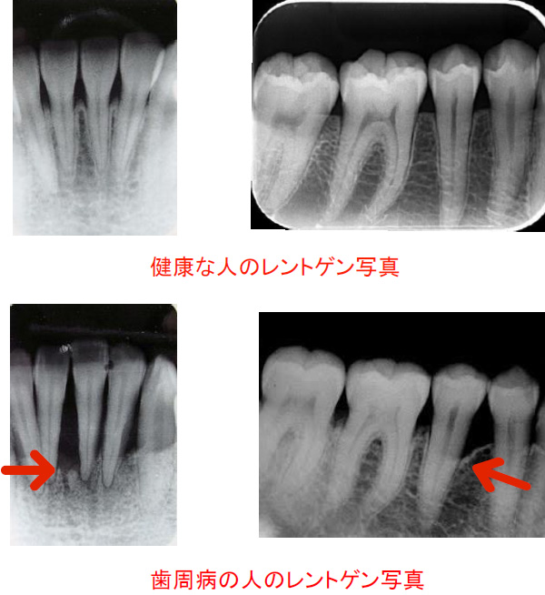 レントゲン写真で見る歯周病