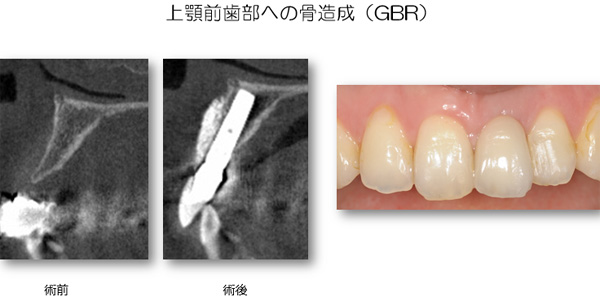 上顎前歯部への骨造成（GBR）
