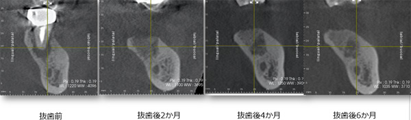 CTレントゲン写真で骨の回復具合を確認